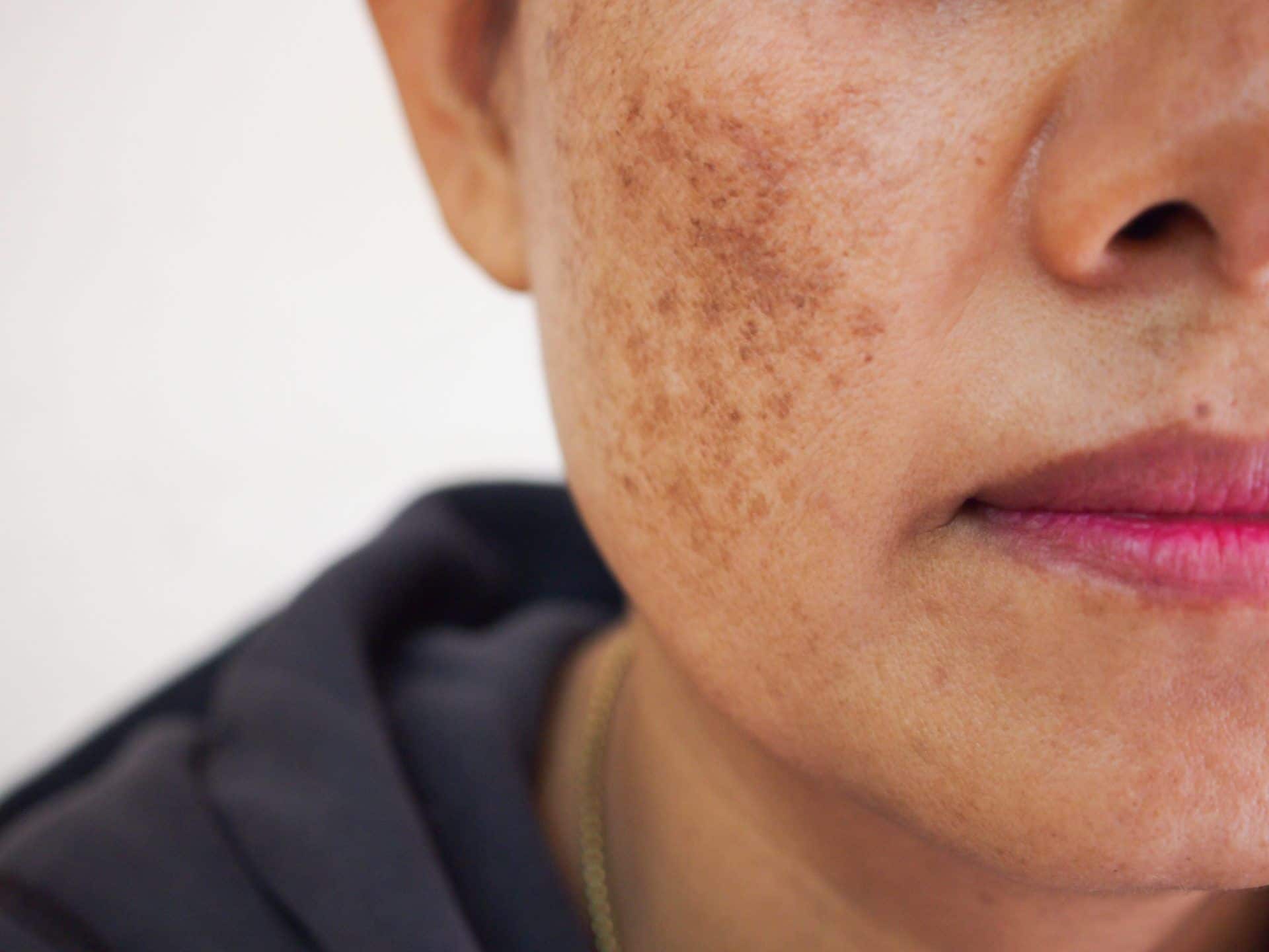 Bochecha direita de uma mulher repleta de manchas escurecidas conhecidas como melasma